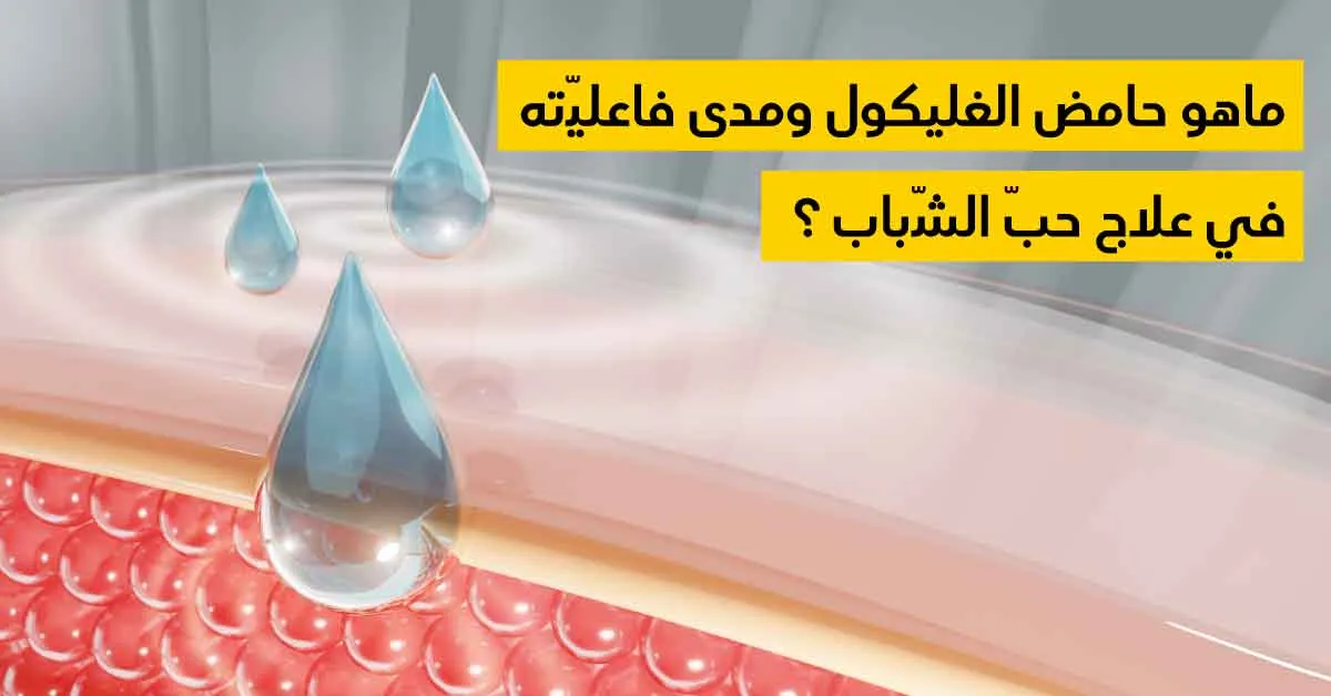 ماهو حامض الغليكول ومدى فاعليّته في علاج حبّ الشّباب ؟